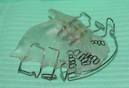 Placca di contenzione Superiore di mantenimanto con ganci di Adams e molle di vestibolarizzazioe dei denri anteriori con cui è possibile agire attivamente sugli incisivi anteriori qualora si presentassero delle recidive