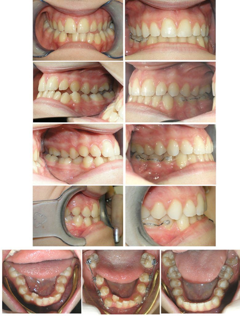 Malocclusine di terza classe in dentizione permanente