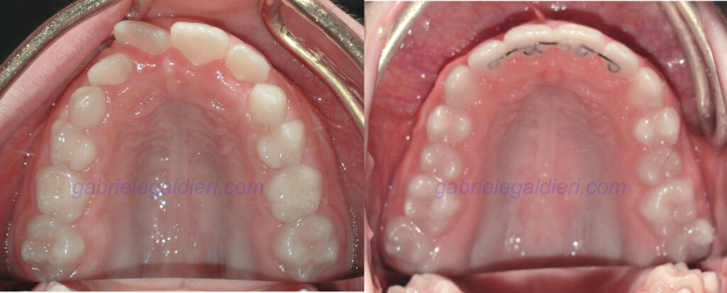 trattamento ortodontico 
terapia morfofunzionale
