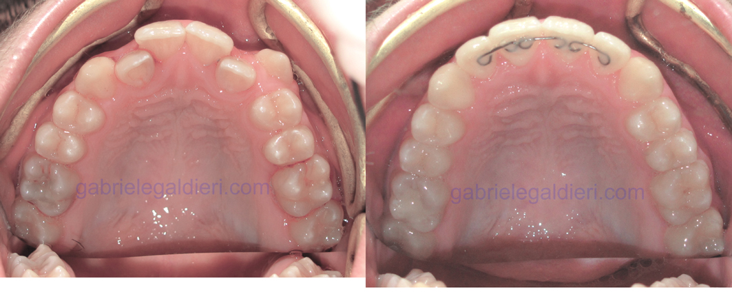 Trattamento Ortodontico Fisso prima e dopo